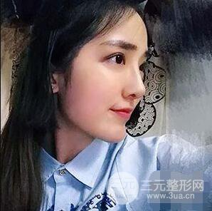 杭州格萊美張樹功假體隆鼻前后對比圖|內(nèi)附恢復(fù)心情變化哦