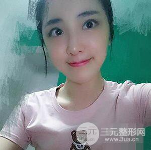 杭州格萊美張樹功假體隆鼻前后對比圖|內(nèi)附恢復(fù)心情變化哦