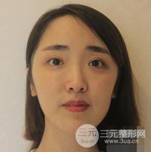 杭州格萊美張樹功假體隆鼻前后對比圖|內(nèi)附恢復(fù)心情變化哦