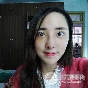 杭州格萊美張樹功假體隆鼻前后對比圖|內(nèi)附恢復(fù)心情變化哦