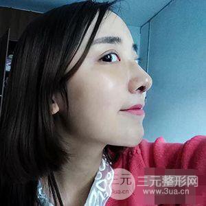 杭州格萊美張樹功假體隆鼻前后對比圖|內(nèi)附恢復(fù)心情變化哦