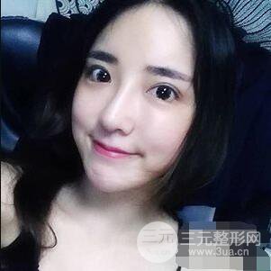 杭州格萊美張樹功假體隆鼻前后對比圖|內(nèi)附恢復(fù)心情變化哦