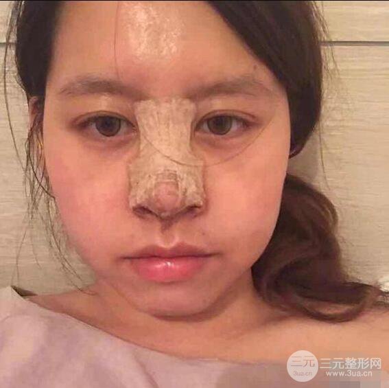 重慶華美何春濤硅膠隆鼻前后對(duì)比圖 內(nèi)附恢復(fù)心情小札