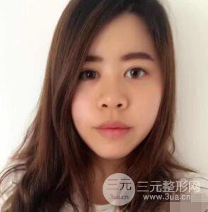 重慶華美何春濤硅膠隆鼻前后對(duì)比圖 內(nèi)附恢復(fù)心情小札