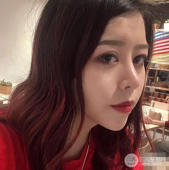 重慶華美何春濤硅膠隆鼻前后對(duì)比圖 內(nèi)附恢復(fù)心情小札