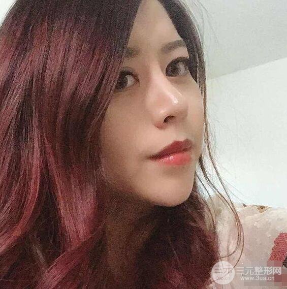 重慶華美何春濤硅膠隆鼻前后對(duì)比圖 內(nèi)附恢復(fù)心情小札