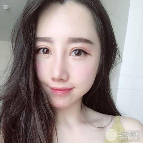 北京聯(lián)合麗格吳焱秋耳軟骨隆鼻前后對(duì)比圖|塌鼻子的救星