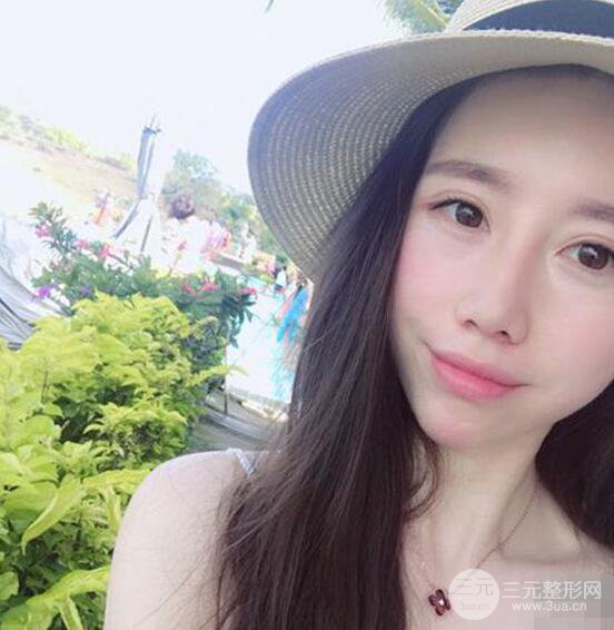 北京聯(lián)合麗格吳焱秋耳軟骨隆鼻前后對(duì)比圖|塌鼻子的救星