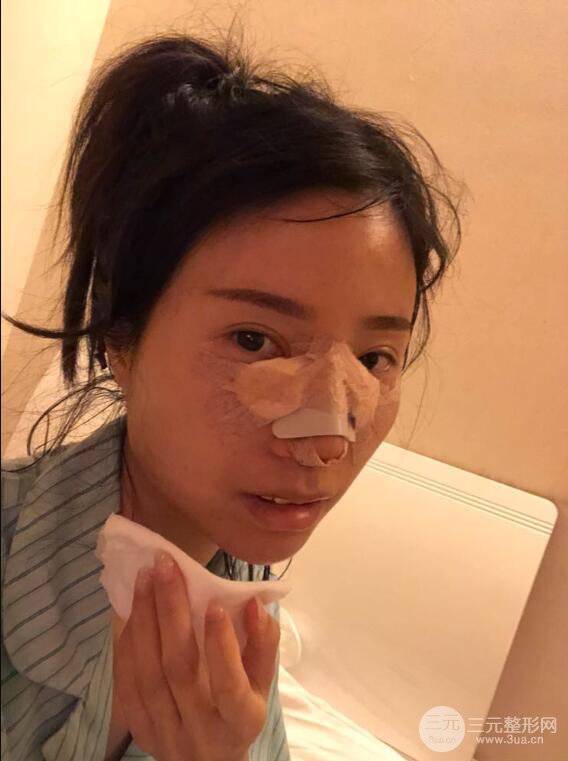 昆明華美美萊楊繼紅肋軟骨隆鼻前后對比圖恢復手札
