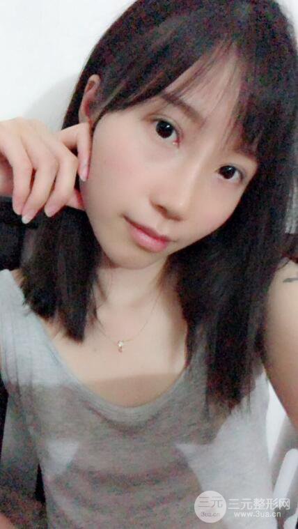 昆明華美美萊楊繼紅肋軟骨隆鼻前后對比圖恢復手札