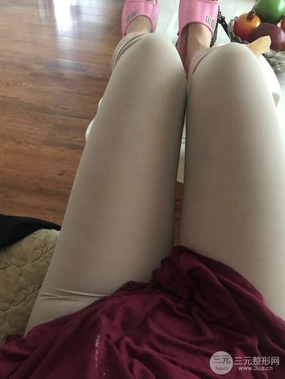 德陽東美奧克拉楊華博大腿吸脂前對(duì)對(duì)比圖 四個(gè)月恢復(fù)變化小記