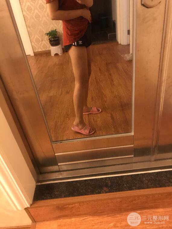 德陽東美奧克拉楊華博大腿吸脂前對(duì)對(duì)比圖 四個(gè)月恢復(fù)變化小記