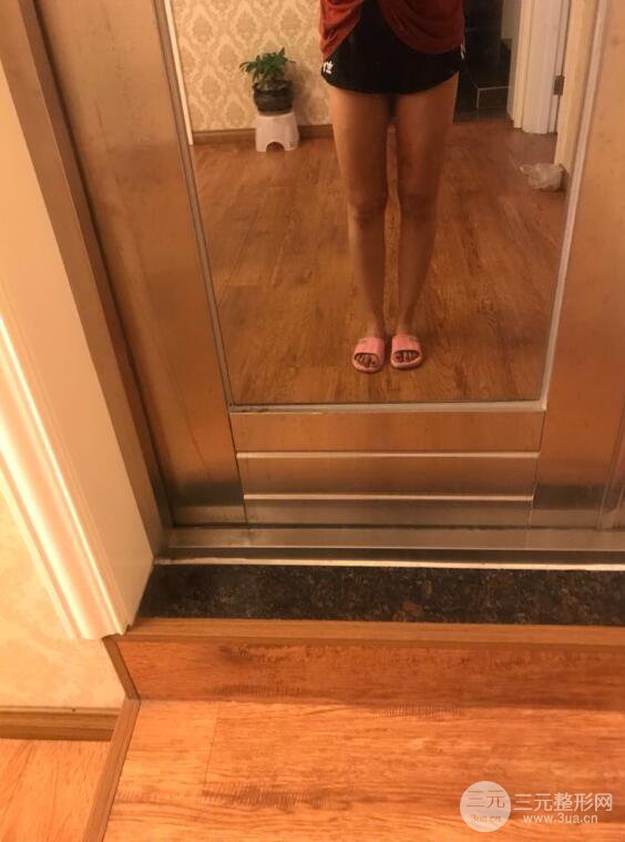 德陽東美奧克拉楊華博大腿吸脂前對(duì)對(duì)比圖 四個(gè)月恢復(fù)變化小記