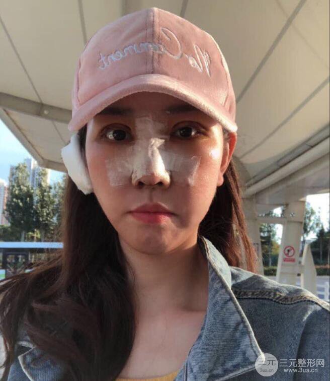 松原齊飛隆鼻整形+雙眼皮一個月前后對比圖真人案例小札