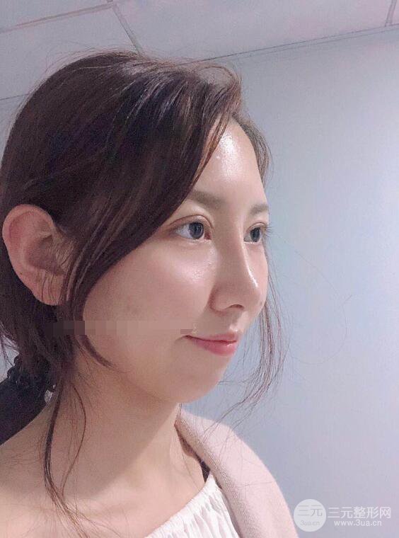 松原齊飛隆鼻整形+雙眼皮一個月前后對比圖真人案例小札