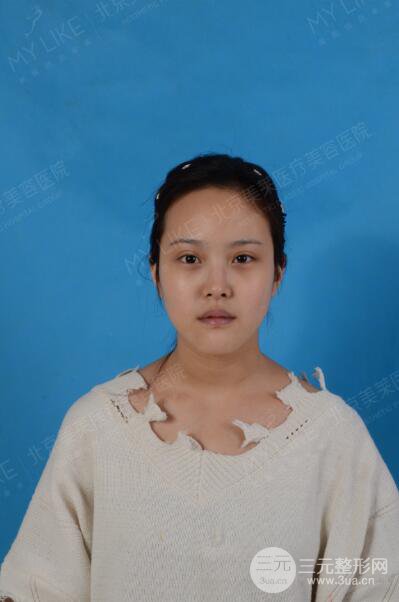 北京美萊趙峻賢隆鼻整形真實案例對比圖恢復(fù)過程分享