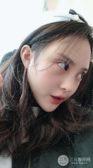 北京美萊趙峻賢隆鼻整形真實案例對比圖恢復(fù)過程分享