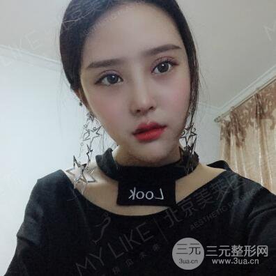 北京美萊趙峻賢隆鼻整形真實案例對比圖恢復(fù)過程分享