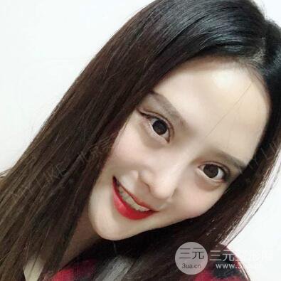 北京美萊趙峻賢隆鼻整形真實案例對比圖恢復(fù)過程分享