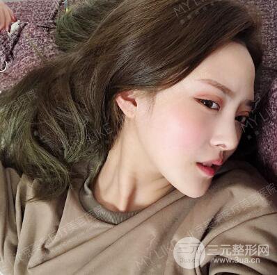 北京美萊趙峻賢隆鼻整形真實案例對比圖恢復(fù)過程分享