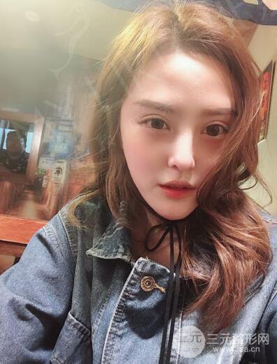 北京美萊趙峻賢隆鼻整形真實案例對比圖恢復(fù)過程分享