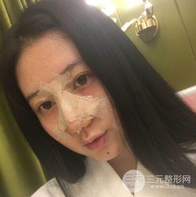 合肥壹加壹王大勇假體隆鼻果對比圖 45天恢復(fù)心路歷程