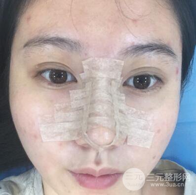 合肥壹加壹王大勇假體隆鼻果對比圖 45天恢復(fù)心路歷程