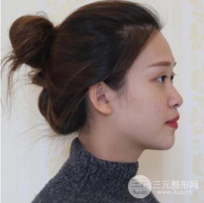 哈爾濱哈美萊鄭東學(xué)隆鼻整形案例對(duì)比圖真實(shí)心情分享喲~