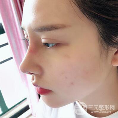 哈爾濱哈美萊鄭東學(xué)隆鼻整形案例對(duì)比圖真實(shí)心情分享喲~