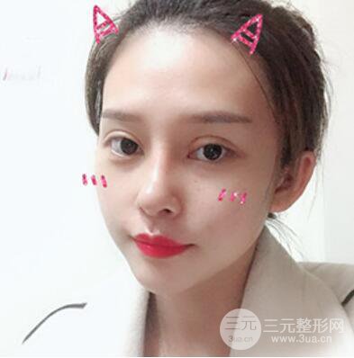 哈爾濱哈美萊鄭東學(xué)隆鼻整形案例對(duì)比圖真實(shí)心情分享喲~