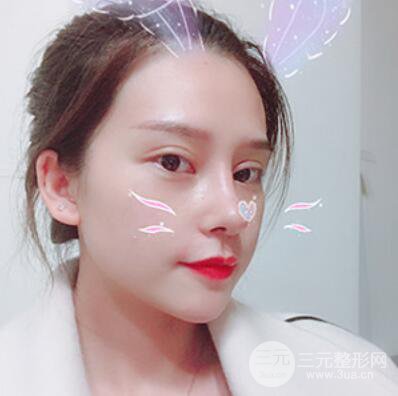 哈爾濱哈美萊鄭東學(xué)隆鼻整形案例對(duì)比圖真實(shí)心情分享喲~