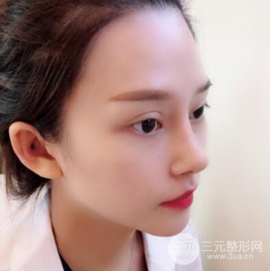 哈爾濱哈美萊鄭東學(xué)隆鼻整形案例對(duì)比圖真實(shí)心情分享喲~