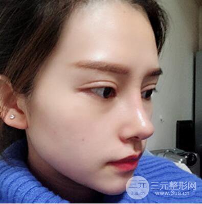 哈爾濱哈美萊鄭東學(xué)隆鼻整形案例對(duì)比圖真實(shí)心情分享喲~