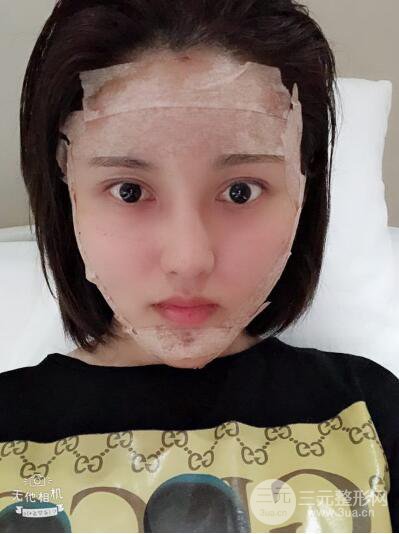 常州施爾美廉鋒自體脂肪豐臉對(duì)照?qǐng)D案例心情日扎