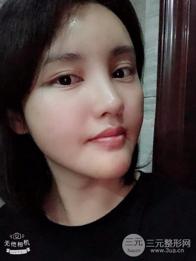 常州施爾美廉鋒自體脂肪豐臉對(duì)照?qǐng)D案例心情日扎