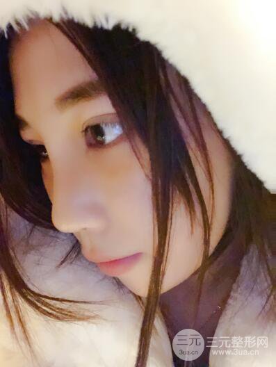 貴陽(yáng)麗都李觀龍隆鼻整形案例對(duì)照?qǐng)D一個(gè)月恢復(fù)過(guò)程分享