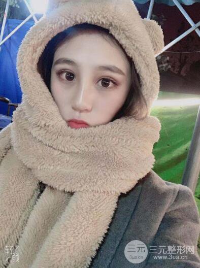 貴陽(yáng)麗都李觀龍隆鼻整形案例對(duì)照?qǐng)D一個(gè)月恢復(fù)過(guò)程分享