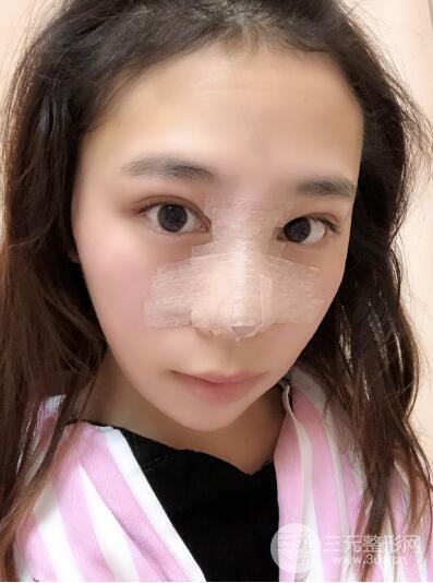 貴陽(yáng)麗都李觀龍隆鼻整形案例對(duì)照?qǐng)D一個(gè)月恢復(fù)過(guò)程分享