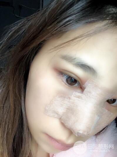 貴陽(yáng)麗都李觀龍隆鼻整形案例對(duì)照?qǐng)D一個(gè)月恢復(fù)過(guò)程分享