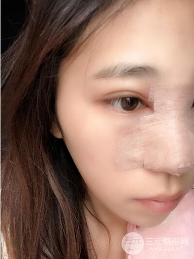 貴陽(yáng)麗都李觀龍隆鼻整形案例對(duì)照?qǐng)D一個(gè)月恢復(fù)過(guò)程分享