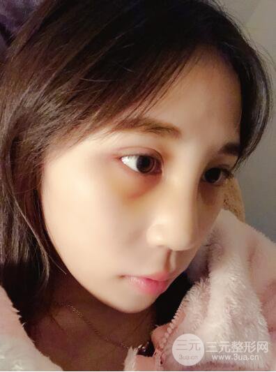 貴陽(yáng)麗都李觀龍隆鼻整形案例對(duì)照?qǐng)D一個(gè)月恢復(fù)過(guò)程分享