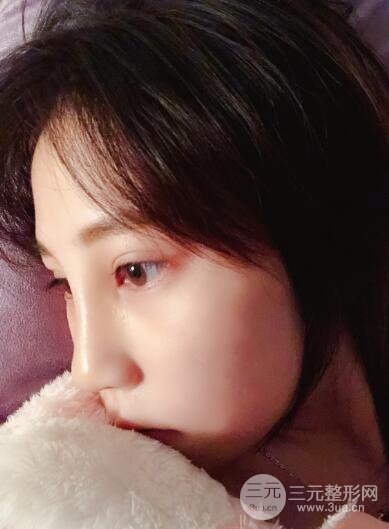 貴陽(yáng)麗都李觀龍隆鼻整形案例對(duì)照?qǐng)D一個(gè)月恢復(fù)過(guò)程分享