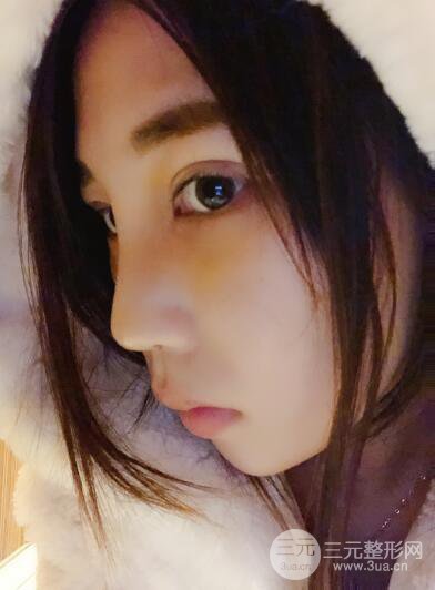 貴陽(yáng)麗都李觀龍隆鼻整形案例對(duì)照?qǐng)D一個(gè)月恢復(fù)過(guò)程分享