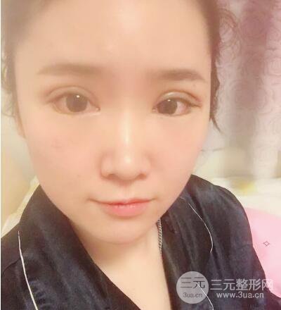 貴陽(yáng)美萊梁潔芭比媚雙眼皮多項(xiàng)整形前后對(duì)比圖恢復(fù)心情小札