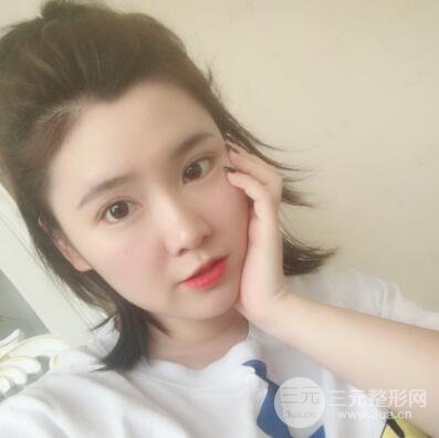 貴陽(yáng)美萊梁潔芭比媚雙眼皮多項(xiàng)整形前后對(duì)比圖恢復(fù)心情小札