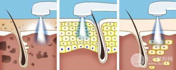 什么是ipl光子嫩膚？原理是什么？