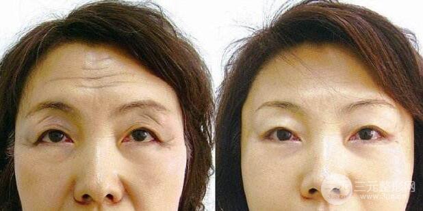 成都去抬頭紋要多少錢?