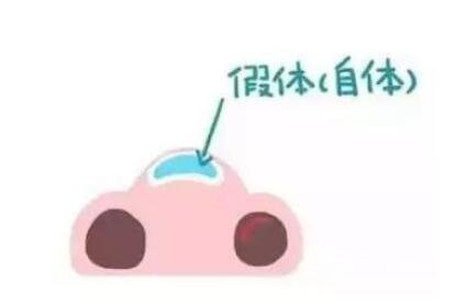 骨膜下隆鼻整形手術(shù)怎么做的？哪種情況適合做？