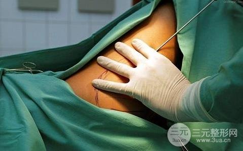 大腿吸脂風(fēng)險(xiǎn)