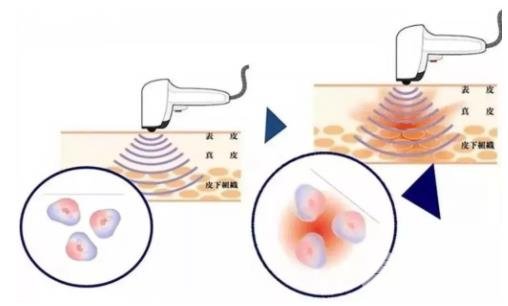 誰(shuí)做過(guò)彩光嫩膚有果嗎 誰(shuí)做過(guò)彩光嫩膚有果嗎